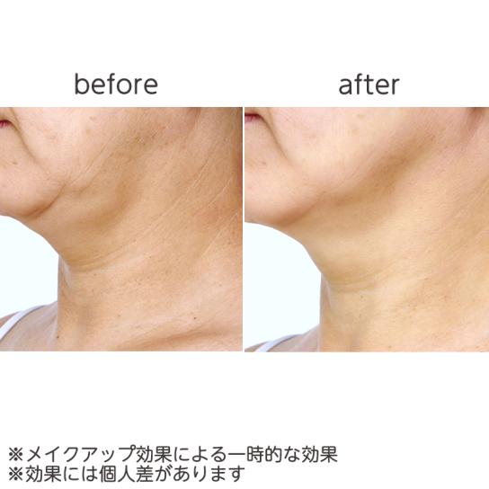 シワ　ラジオ波　サマル　高周波 製品詳細 | 村中医療器株式会社 | 高周波ラジオ波メス サージ