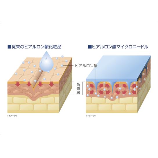 クオニス ダーマフィラー アイニードル 4回分 [H251710